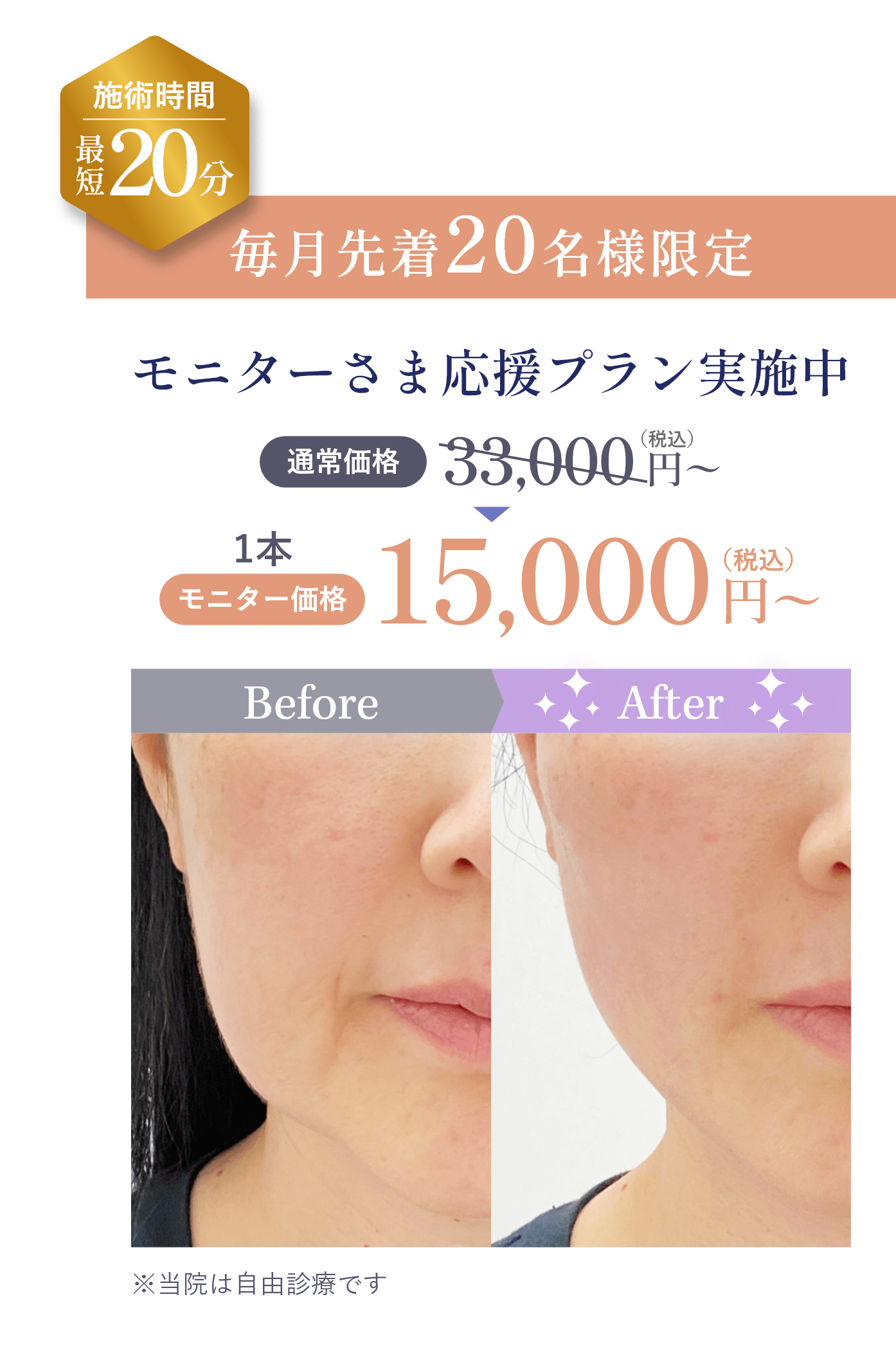 切らない目の下のクマ・たるみとり